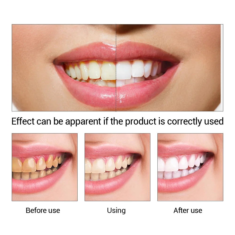 FTEENPLY ฟันไวท์เทนนิ่ง Oral ส - Teeth Whitening Zimba บทวิจารณ์และราคา