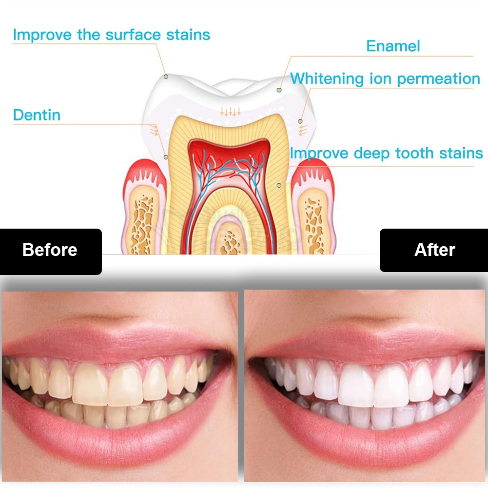 ทันตกรรมชุดฟอกสีฟัน Mini 16 LE - Teeth Whitening Groupon บทวิจารณ์และราคา